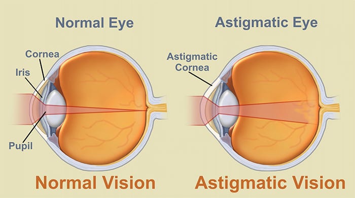 Astigmatism-Meaning-Middle-East