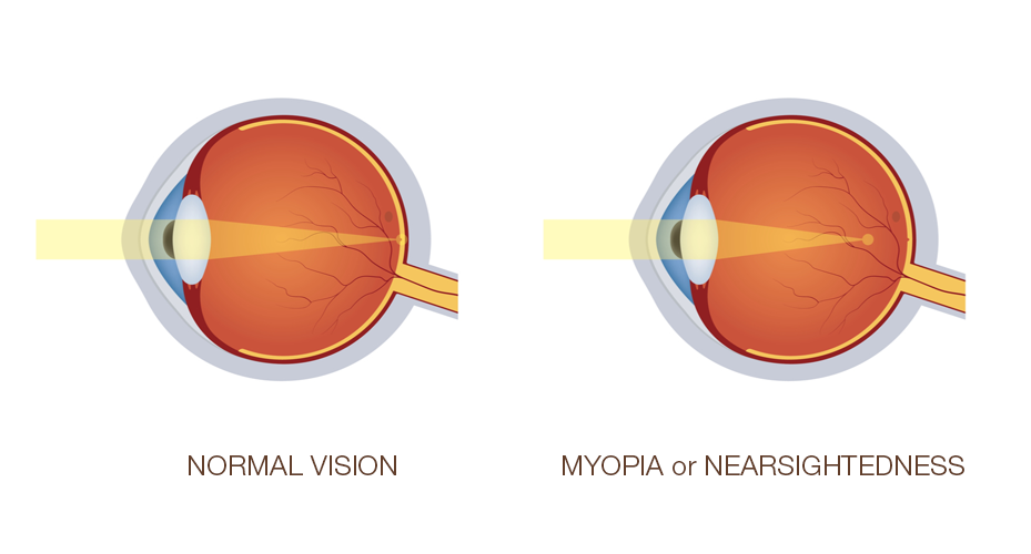 What Is Myopia or Nearsightedness?