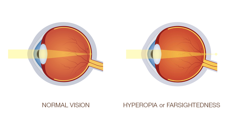 What Is Hyperopia or Farsightedness?