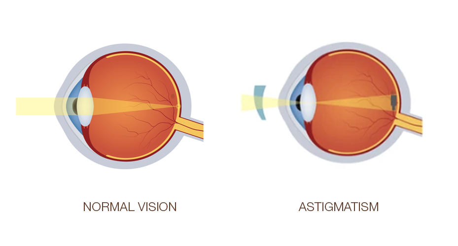 What is Astigmatism or Toric Lenses?